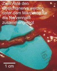 Fazialisparese Gesichtslähmung NF2 Bundesverband Neurofibromatose