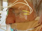 monitoring Gesichtsnerv NF2 Mikrochirurgie Bundesverband Neurofibromatose