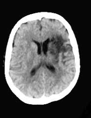 NF2 Hirnscan Computertomografie Neurofibromatose Diagnostik