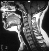 Neurofibromatose Typ 2 NF2 Tumor Hörnerv Hirnhaut Rücken Wirbelsäule