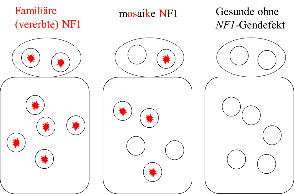 Vererbung NF1 Mosaikbildung Vererbte und Mosaikbildung NF1 NEurofibromatose Typ 1